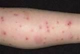 Bed Bug Bite Pictures On Humans Pictures