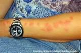 Pictures of Bed Bug Bites Pictures On Humans