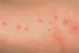 Pictures of Bed Bug Bite Pictures On Humans
