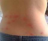 Pictures Of Bed Bug Bites Photos