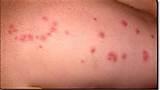 Bed Bug Bite Pictures On Humans Photos