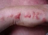 Photos of Bed Bug Bites Images