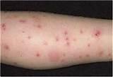 Bed Bug Bites Images