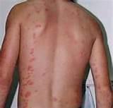 Pictures of Bed Bug Bite Pictures On Humans