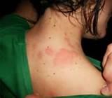 Bed Bug Bite Pictures On Humans Images