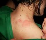 Bed Bug Bite Pictures On Humans Images