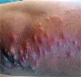 Bed Bug Bite Pictures On Humans Images