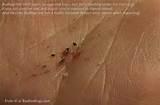 Bed Bug Bites Images