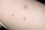 Photos of Bed Bug Bite Pictures On Humans