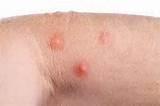 Images of Bed Bug Bites Pictures On Humans