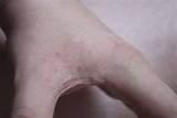 Images of Bed Bug Bites Images