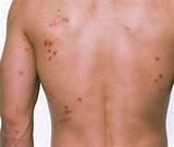 Images of Bed Bug Bites Images