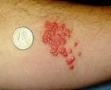 Images of Bed Bug Bite Pictures On Humans