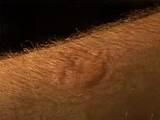 Bed Bug Bites Images Photos
