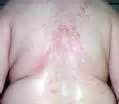 Bed Bug Bites Pictures On Humans Photos