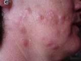 Photos of Bed Bug Bites Images