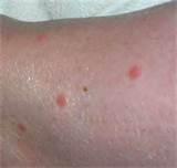 Images of Bed Bug Bites Images