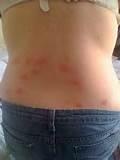Bed Bug Bite Pictures On Humans Images