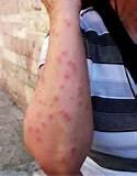 Pictures of Bed Bug Bites Images
