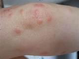 Images of Bed Bug Picture Images of Bed Bug Picture