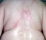Bed Bug Bites Images