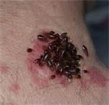 Bed Bug Bite Pictures On Humans Pictures