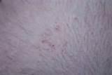Photos of Bed Bug Bite Pictures On Humans
