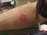 Images of Bed Bug Bites Images