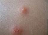 Images of Bed Bug Bites Pictures On Humans