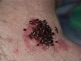 Photos of Bed Bug Bites Pictures On Humans
