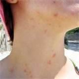 Bed Bug Bites Pictures On Humans Photos