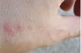 Photos of Bed Bugs Pictures Of Bites