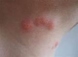 Pictures of Bed Bugs Pictures Of Bites