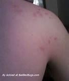 Bed Bug Bites Vs Mosquito Bites Images