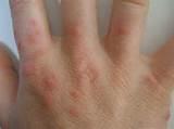 Pictures of Bed Bug Bite Picture