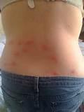 Bed Bug Bite Picture