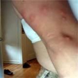 Bed Bugs Pictures Of Bites