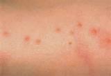 Photos of Bed Bug Bite Picture