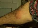 Bed Bugs Pictures Of Bites Images