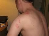 Pictures of Bed Bug Bite Picture