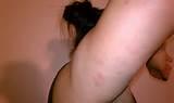 Bed Bug Bite Picture Pictures