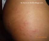 Pictures of Bed Bugs Pictures Of Bites