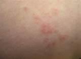 Bed Bug Bite Picture Images