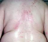 Pictures Of Bed Bugs Bites