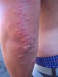 Images of Bed Bug Bite Picture