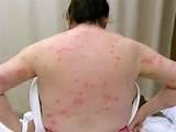 Bed Bugs Symptoms Pictures Images