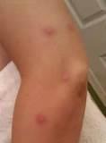 Bed Bugs Pictures Of Bites