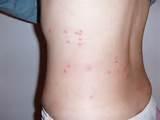 Bed Bug Bite Picture Photos