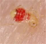 Bed Bug Bite Photo Pictures