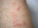 Pictures of Bed Bugs Pictures Of Bites